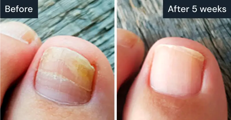 Comparison of toenail before and after five weeks, showing improvement.
